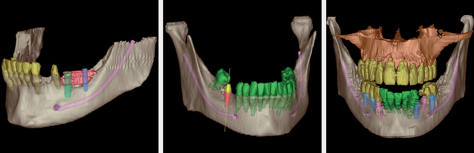 Sichere Diagnostik und präzise Planung von Implantaten